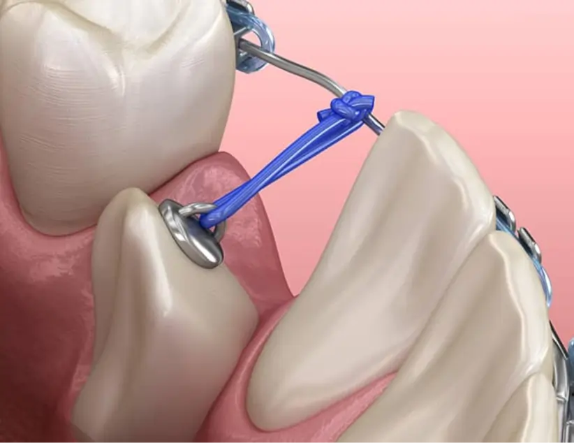 Exposure of Impacted Teeth
