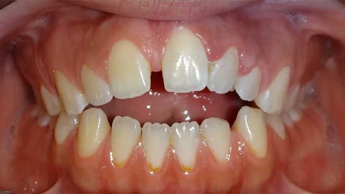 Open Bite before treatment