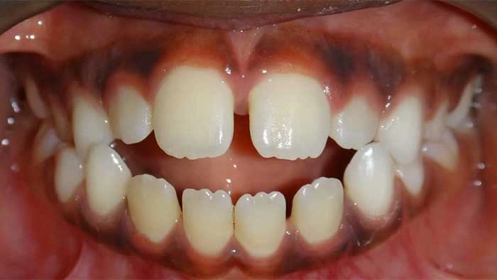 Thumb Habit before treatment