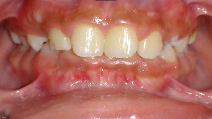 Deep Overbite before treatment