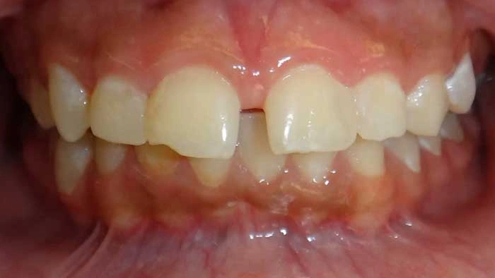 Overjet before treatment