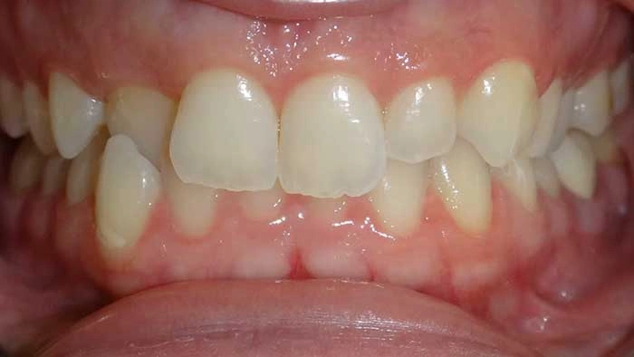 Missing Teeth before treatment