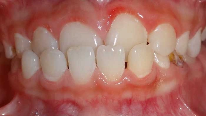 Underbite before treatment