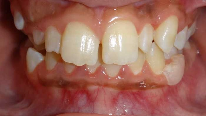 Crowding before treatment