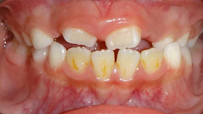Early Treatment before treatment