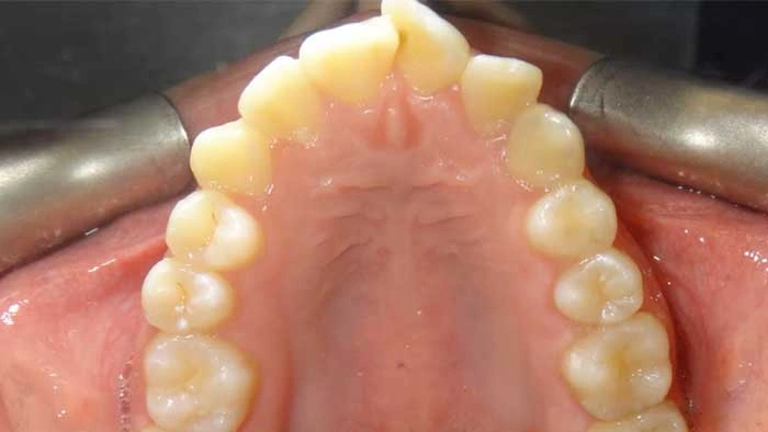 Palatal Expander before treatment