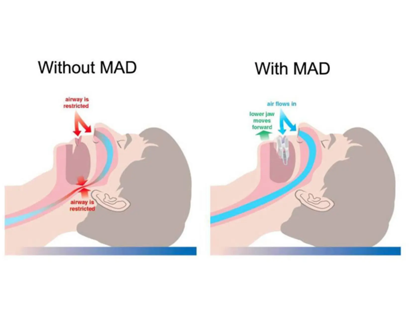 Sleep Apnea Solutions