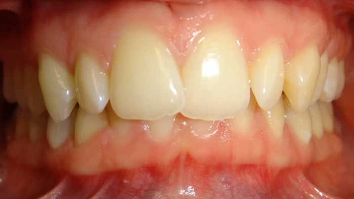 Clear Aligner before treatment