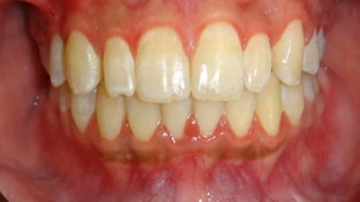 Crowding after treatment