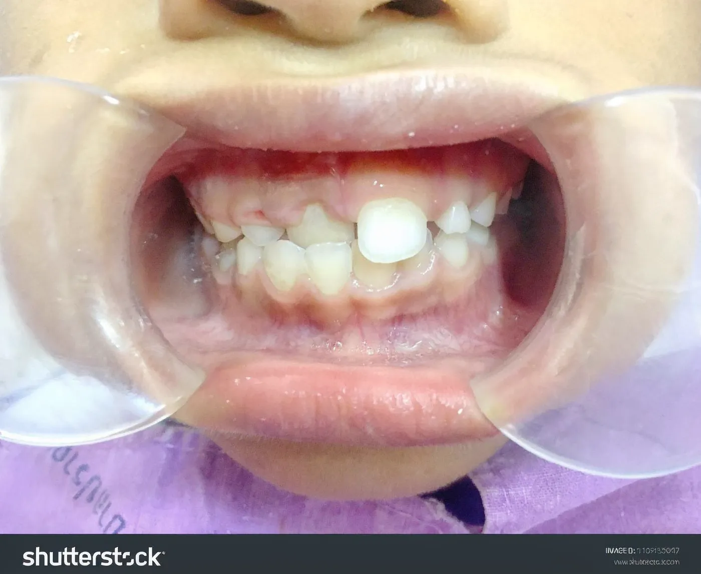 Anterior crossbite of a front tooth in a child