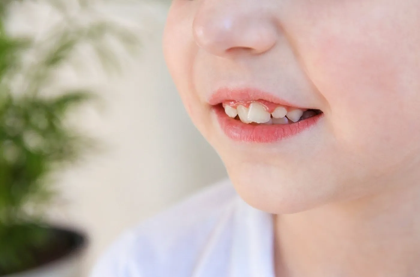 Child with crowded, crooked teeth