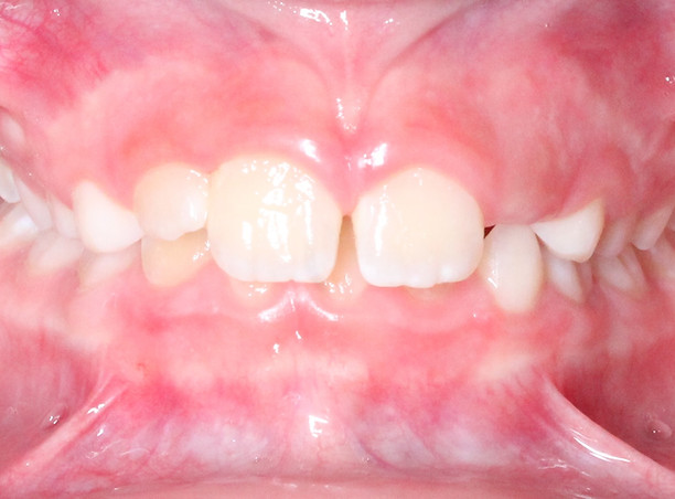 Child's front teeth showing a deep bite