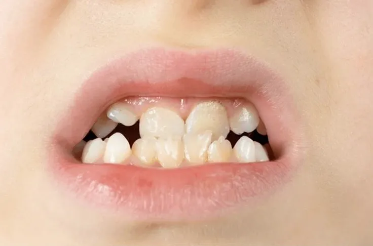 Child's front teeth with an open bite