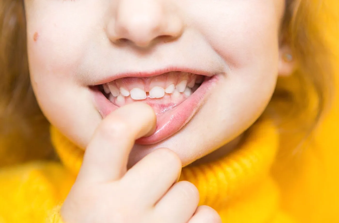 Child showing an overbite malocclusion