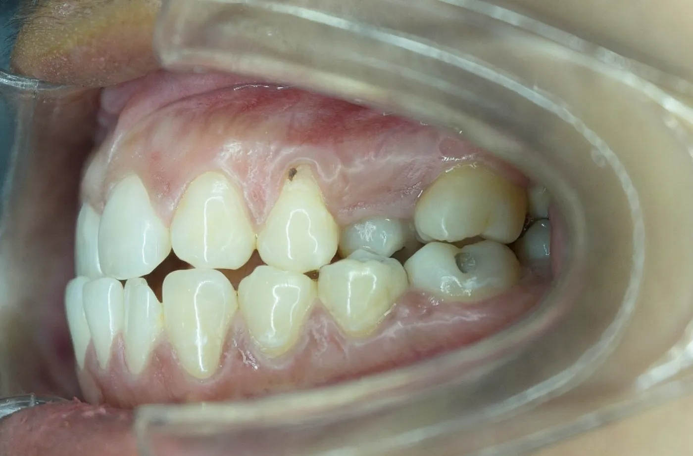 Underbite of front teeth