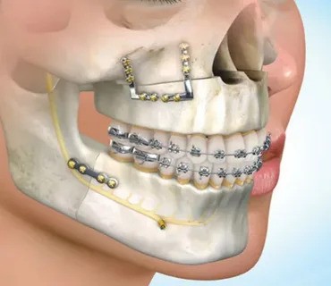 Top 5 Signs You Might Need Braces—Even as an Adult