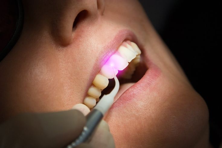 Laser Dental Treatment in Orthodontics