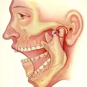 The Connection Between Orthodontics and TMJ Disorder
