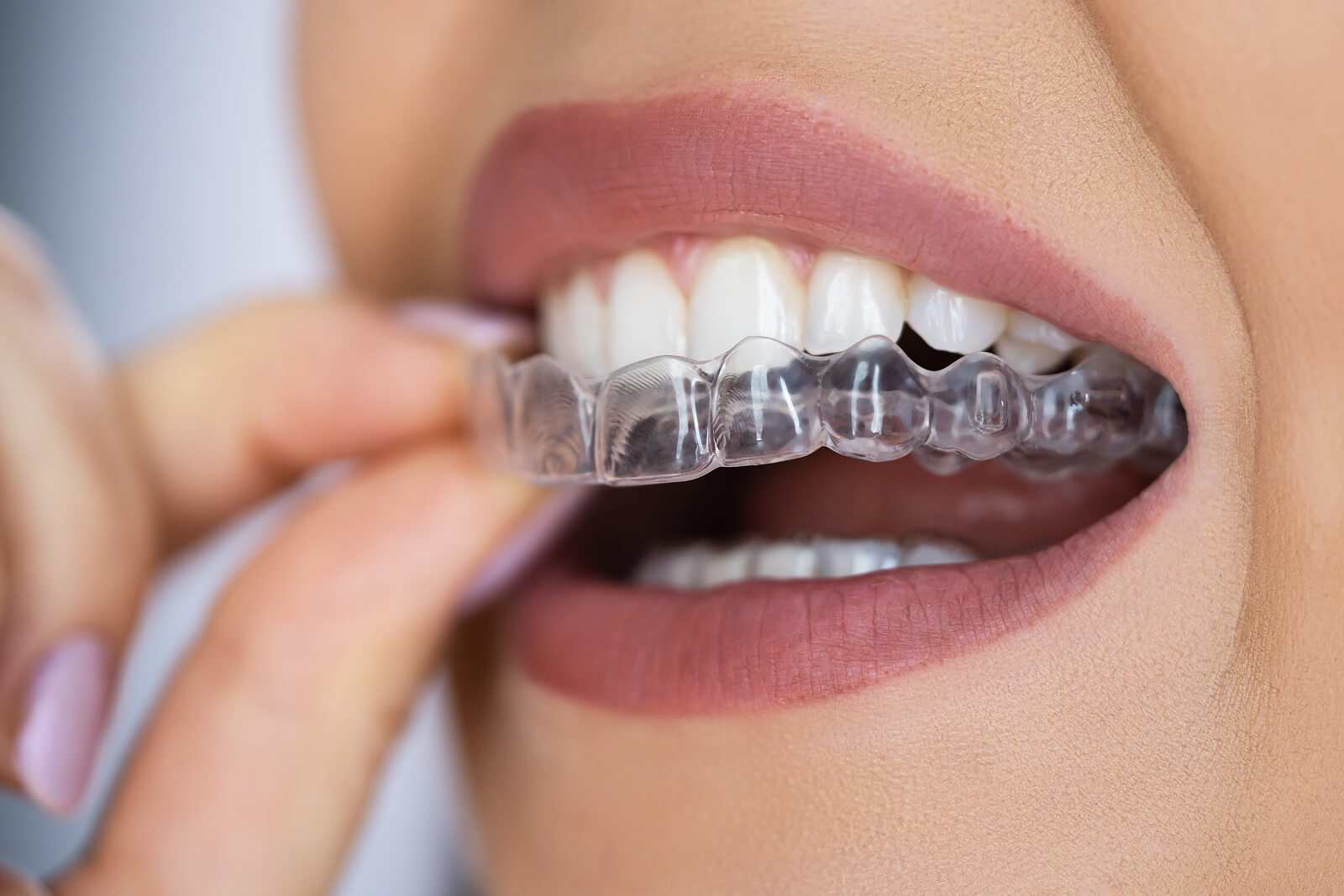 Top Benefits of Affordable Orthodontic Braces
