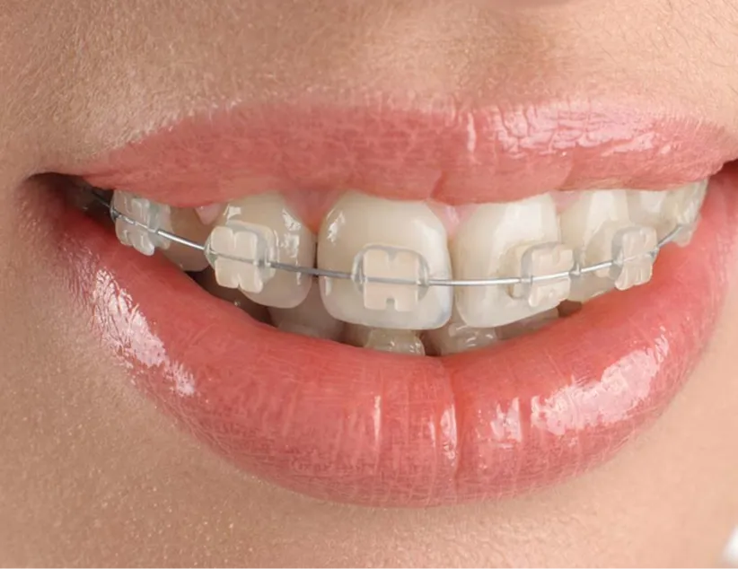 Ceramic braces on teeth