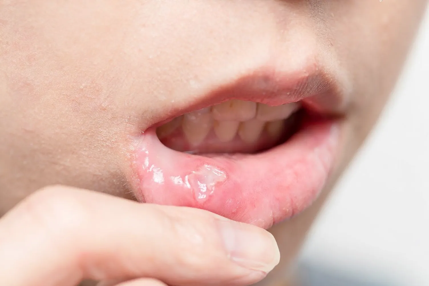 Canker Sore & Ulcer Treatment