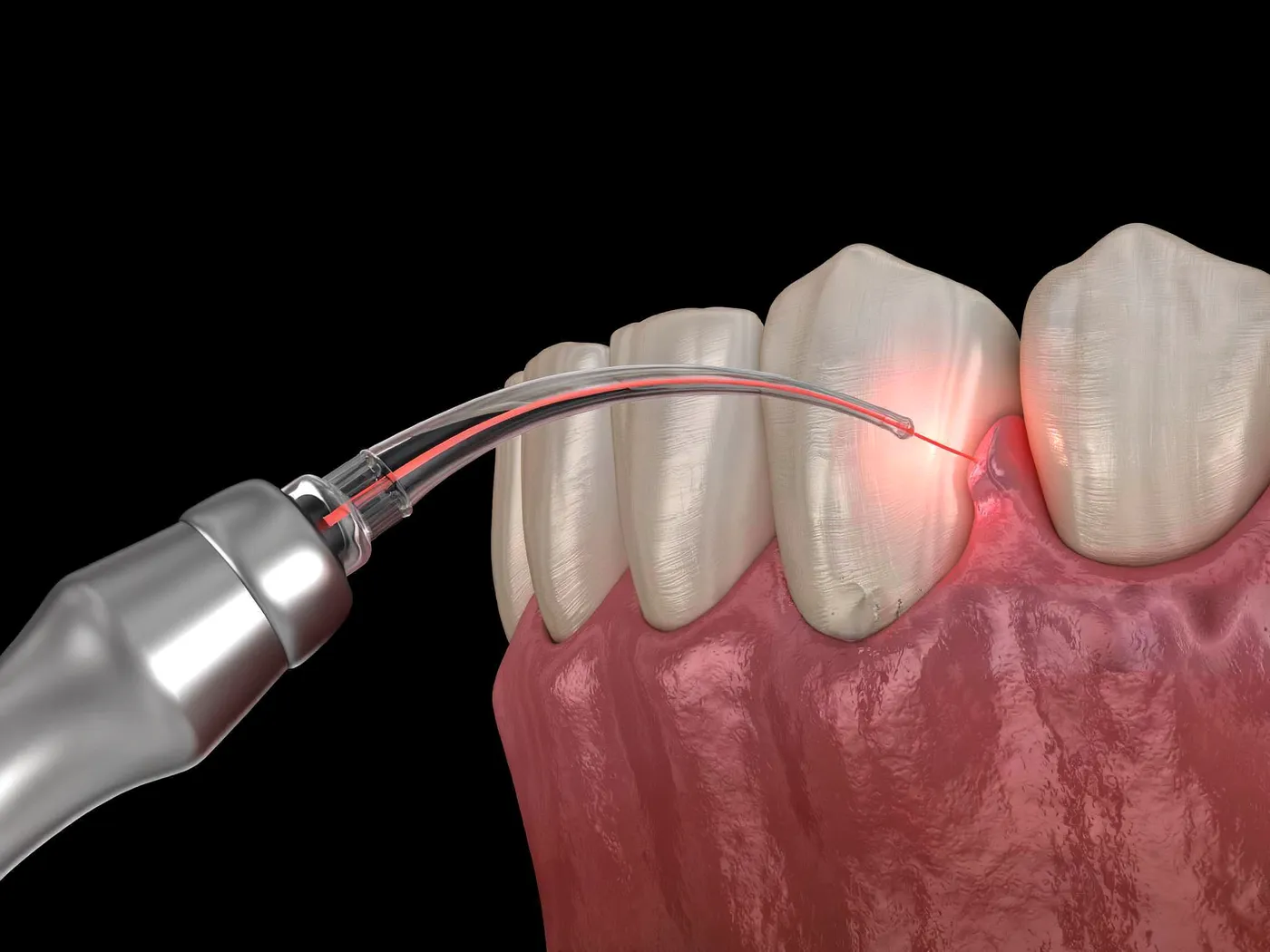 Laser Frenectomy