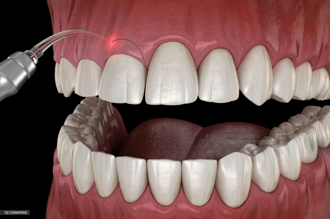 Gum Contouring & Gingivectomy