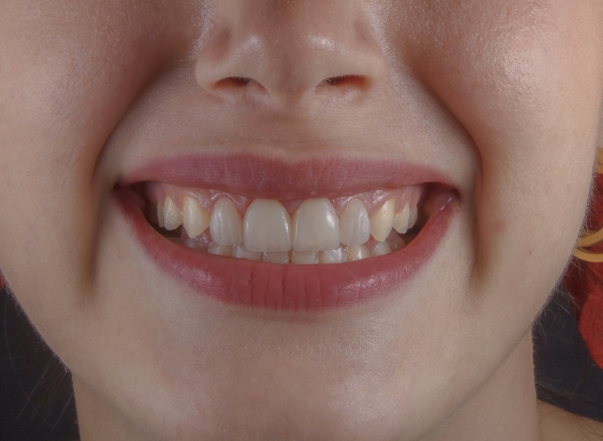 Orthodontic Tooth Exposure