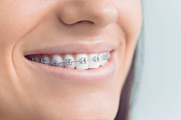 Woman smiling with braces and a perfect smile